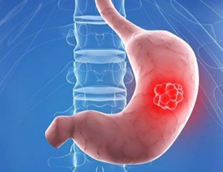 你知道嗎？從慢性胃炎到胃癌，只有四步！